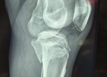 Kas yra blauzdikaulio plokštumos lūžis?