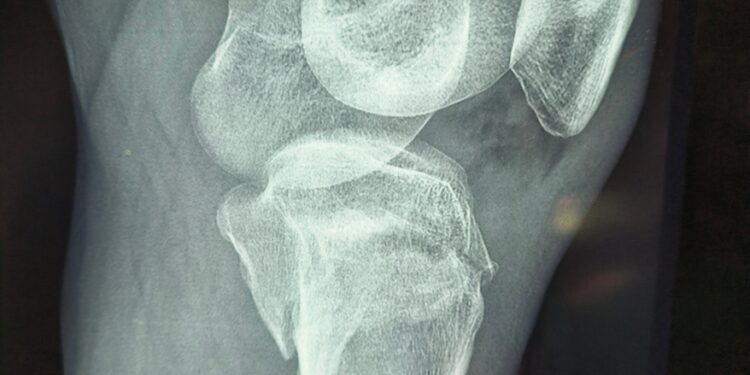 Kas yra blauzdikaulio plokštumos lūžis?