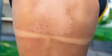 Ką turėtumėte žinoti apie saulės nudegimo pūslės