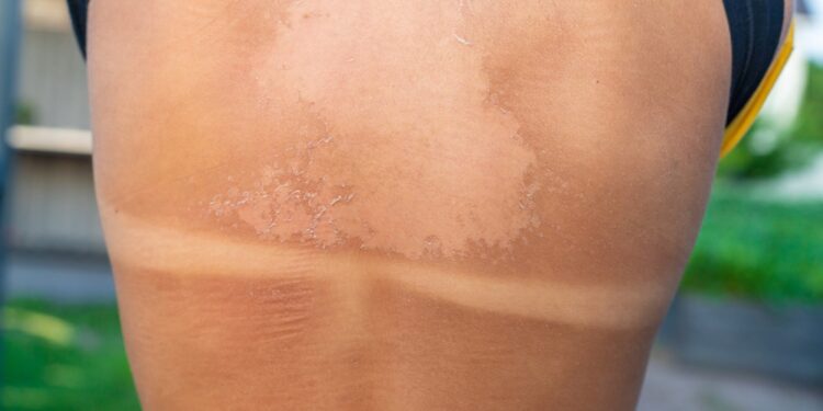 Ką turėtumėte žinoti apie saulės nudegimo pūslės