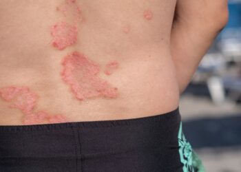 Viskas apie eritroplakiją: atpažinimas, simptomai ir gydymas