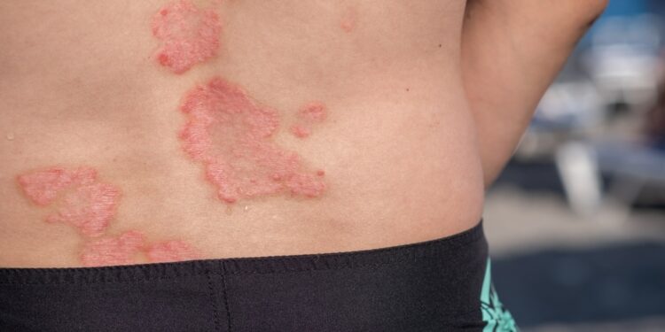 Viskas apie eritroplakiją: atpažinimas, simptomai ir gydymas