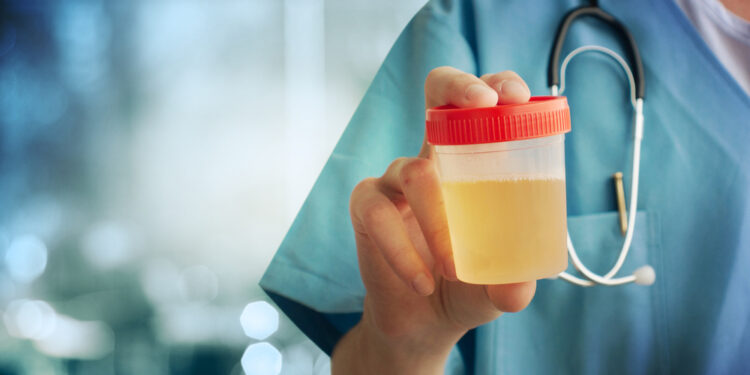 Kodėl mano šlapimas gali kvepėti kava?