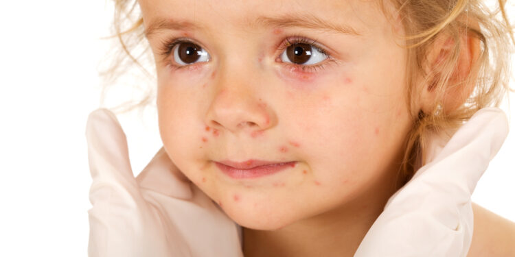 Ar vėjaraupiai gali atsirasti burnoje?