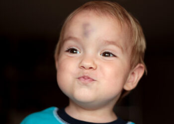 Atsakymai apie cistą ant kaktos