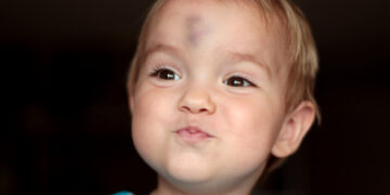 Atsakymai apie cistą ant kaktos