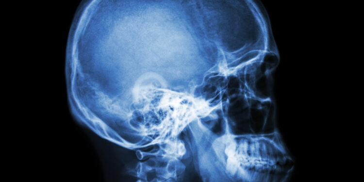 Kaukolės rentgenograma