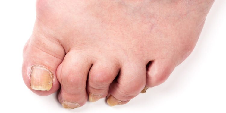 Svarbiausia apie poliartritą