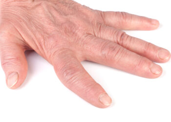 Viskas, ką turite žinoti apie poliartritą