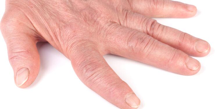 Viskas, ką turite žinoti apie poliartritą