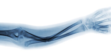 Kubito valgus: ką svarbu žinoti