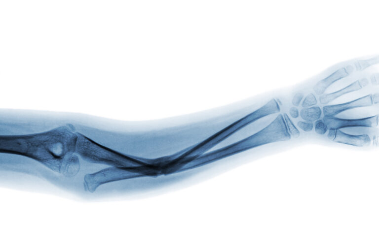Kubito valgus: ką svarbu žinoti