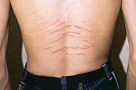 Smakro duobutės formavimo operacija