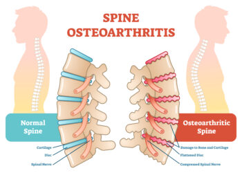 Stuburo suspaudimo lūžis