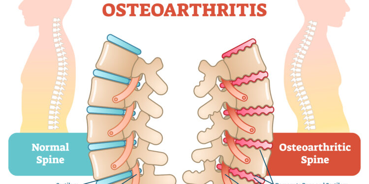 Stuburo suspaudimo lūžis