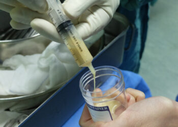 Tensilono mėginys: kas tai ir kodėl šis tyrimas JAV nebenaudojamas miastenijai gravis diagnozuoti