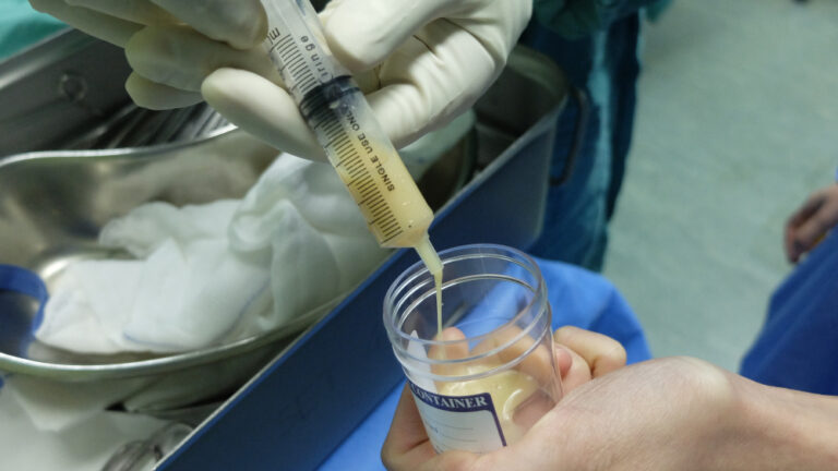 Tensilono mėginys: kas tai ir kodėl šis tyrimas JAV nebenaudojamas miastenijai gravis diagnozuoti
