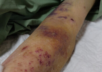 Mano gyvenimas su ITP”