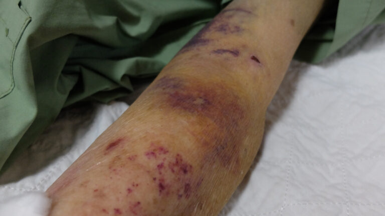 Mano gyvenimas su ITP”