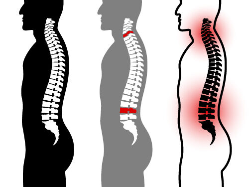 Nugaros smegenų pažeidimas