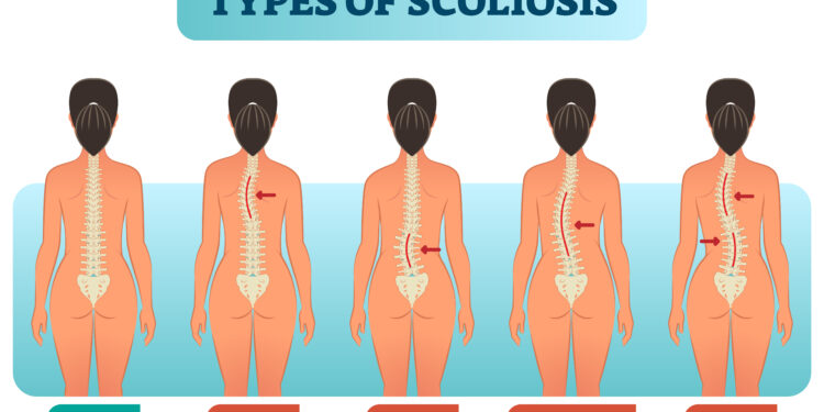 Kaip gydoma skoliozė suaugusiesiems?