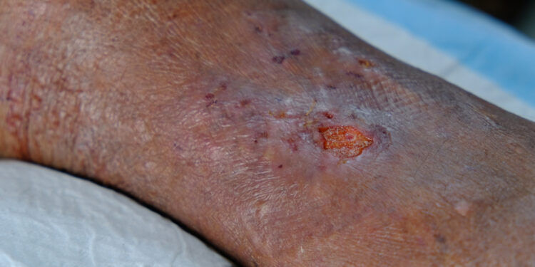 Actininė purpura (senatvinė purpura)