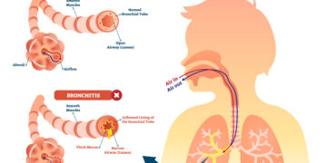 Ko reikėtų vengti vartojant baklofeną?