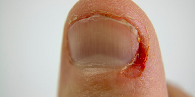 Kaip atpažinti ir gydyti įaugusio nagų infekciją