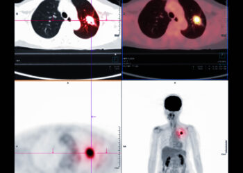 Plaučių PET tyrimas