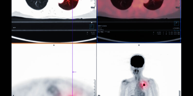 Plaučių PET tyrimas