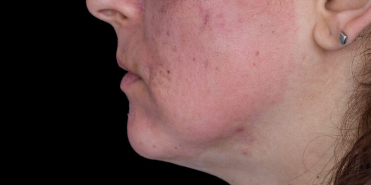 Berinert ir išlaidos: ką svarbu žinoti