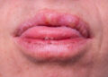 Ar ant lūpų gali atsirasti odos ataugų?