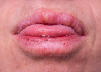Ar ant lūpų gali atsirasti odos ataugų?