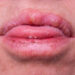 Ar ant lūpų gali atsirasti odos ataugų?