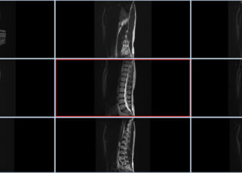 Lumbosakralinės stuburo dalies rentgenograma
