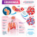 Ar leukemija gali sukelti padidėjusį cukraus kiekį kraujyje?