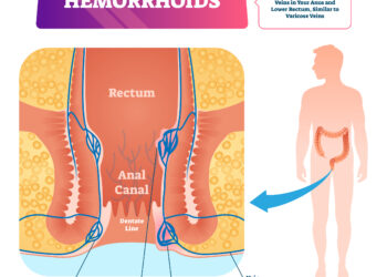 Ar gali hemorojus trūkti ir ar tai pavojinga?