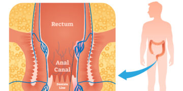 Ar gali hemorojus trūkti ir ar tai pavojinga?