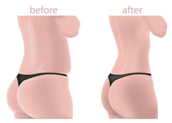 Kas nutinka bambai atliekant pilvo plastikos operaciją?