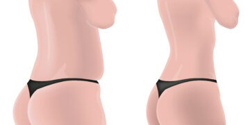 Kas nutinka bambai atliekant pilvo plastikos operaciją?