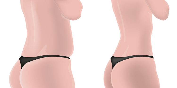 Kas nutinka bambai atliekant pilvo plastikos operaciją?