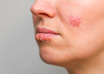 Pūslelinė ant smakro