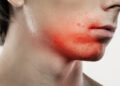 Žandikaulio srities aknė: priežastys, gydymas ir kita informacija