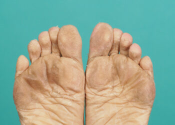 5 puikios priemonės nuo besilupančios pėdų odos