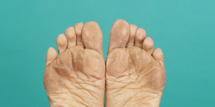 5 puikios priemonės nuo besilupančios pėdų odos