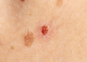 Kas yra Špico nevusas?