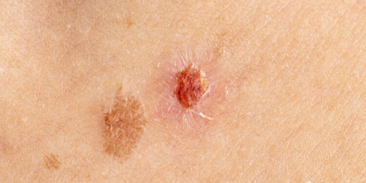 Kas yra Špico nevusas?