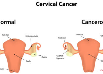 Ar žmogaus papilomos virusas (ŽPV) gali paveikti mano vaisingumą?