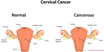 Ar žmogaus papilomos virusas (ŽPV) gali paveikti mano vaisingumą?