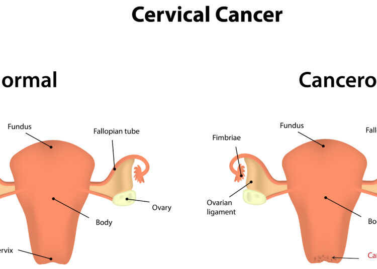 Ar žmogaus papilomos virusas (ŽPV) gali paveikti mano vaisingumą?